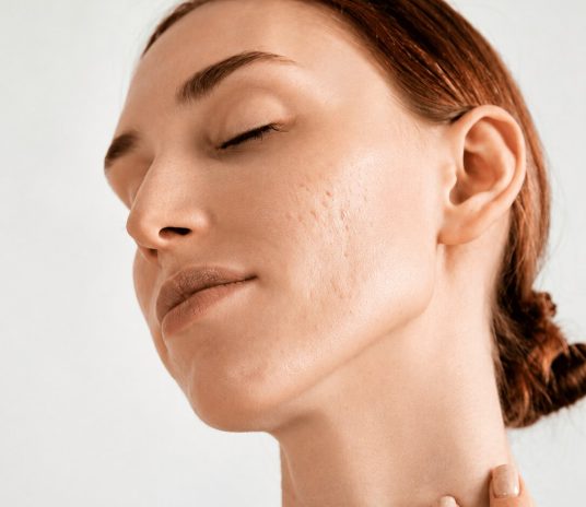 Chemabrasion for Acne img2