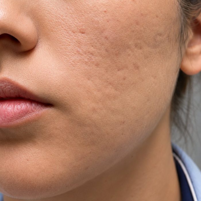 Chemabrasion for Acne2