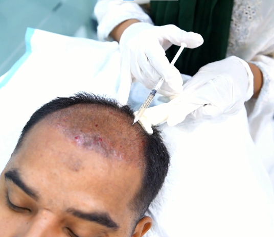 Hair PRP Treatment2