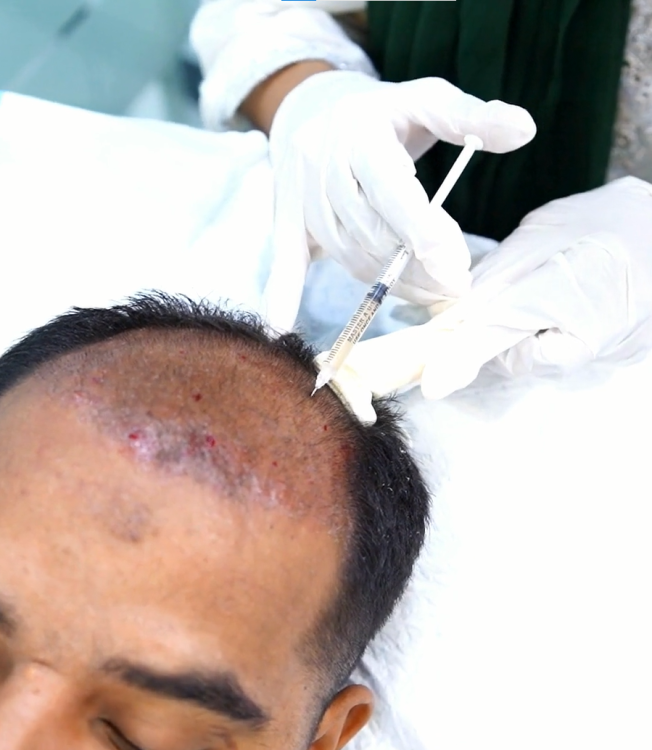Hair PRP Treatment2