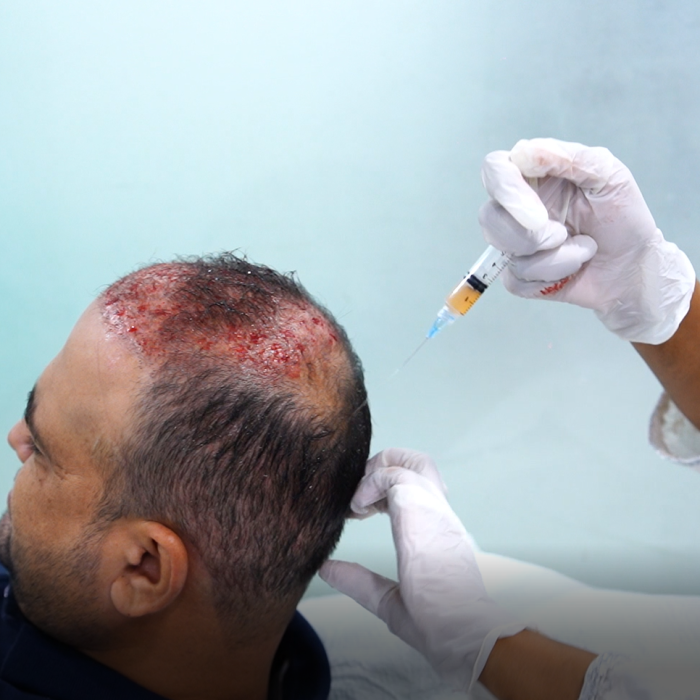 Hair PRP Treatment5