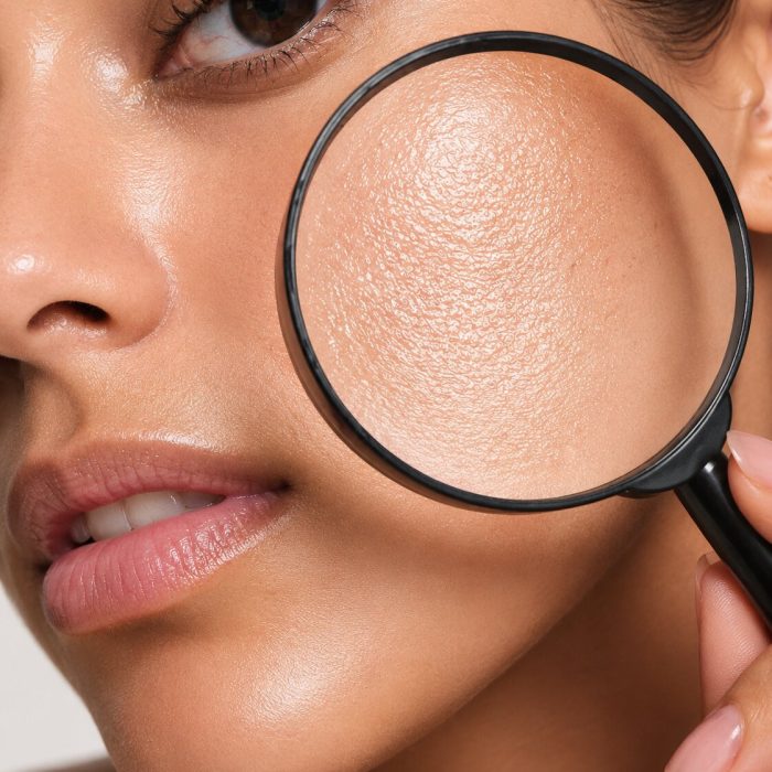 IMG 3 CHEMICAL PEEL