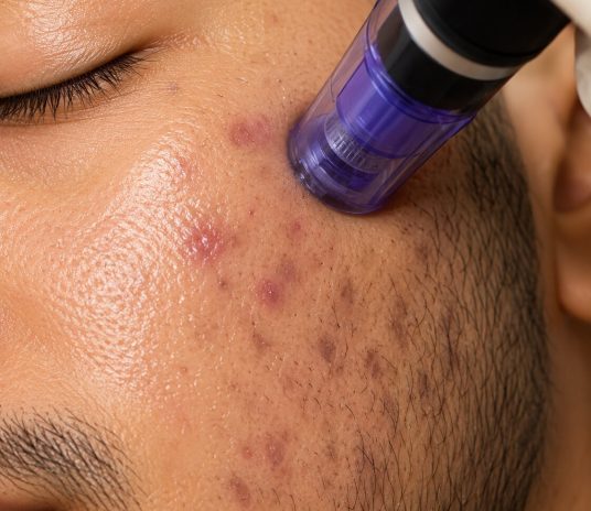 Microdermabrasion Whitening and Acne IMG 1 1