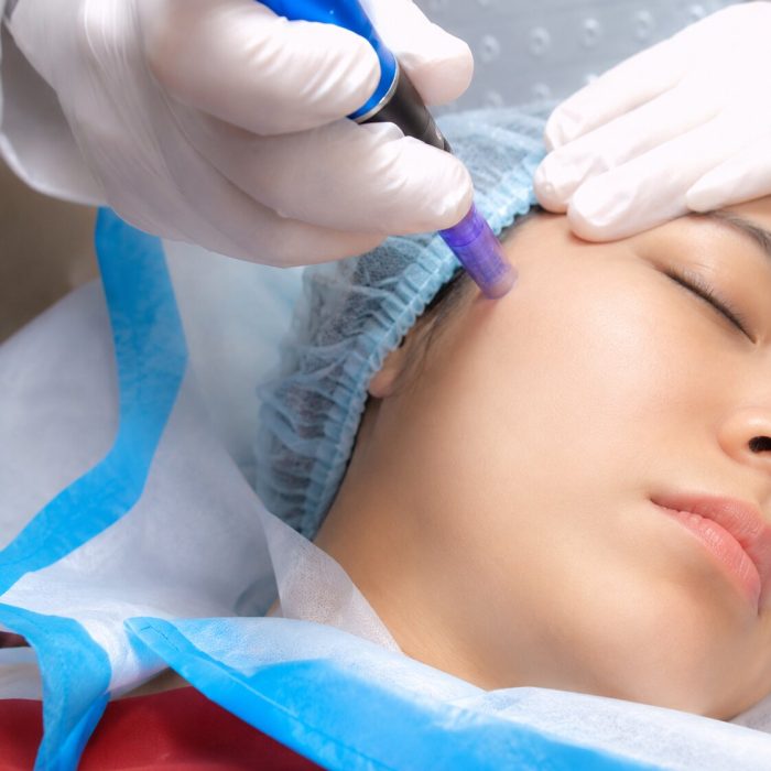 Microdermabrasion Whitening and Acne IMG 3