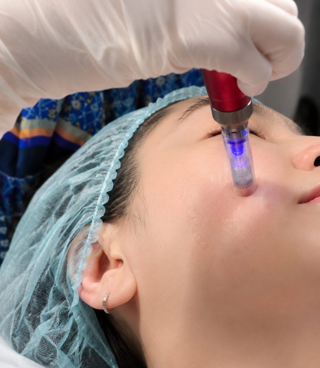 Microdermabrasion Whitening and Acne IMG 4