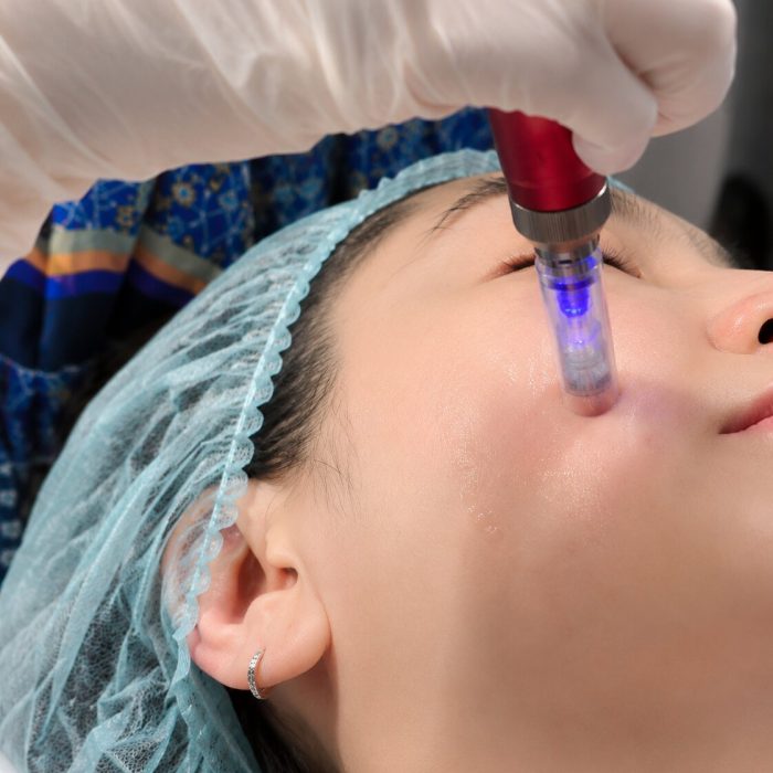Microdermabrasion Whitening and Acne IMG 4