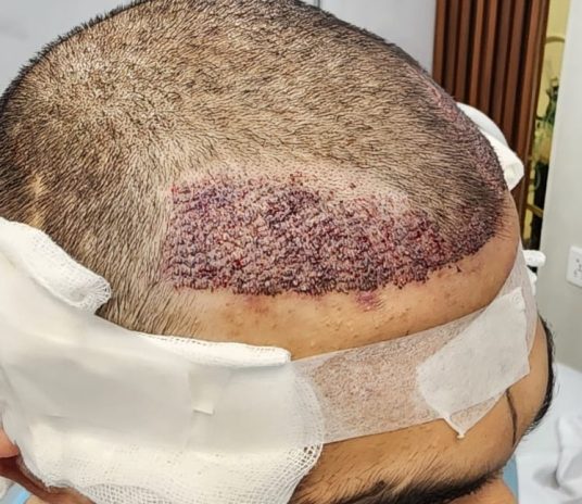 Pakistan Aesthetic Hair Transplant Center-results
