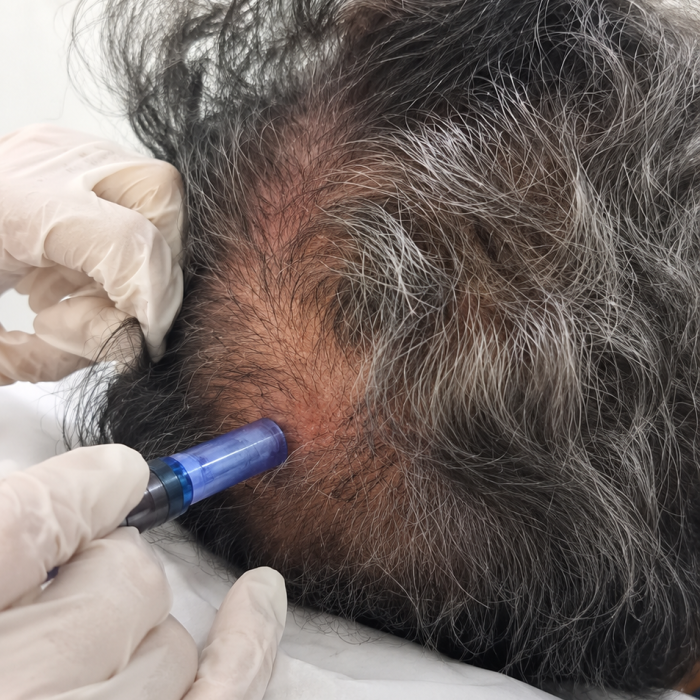 Stem Cell Therapy3