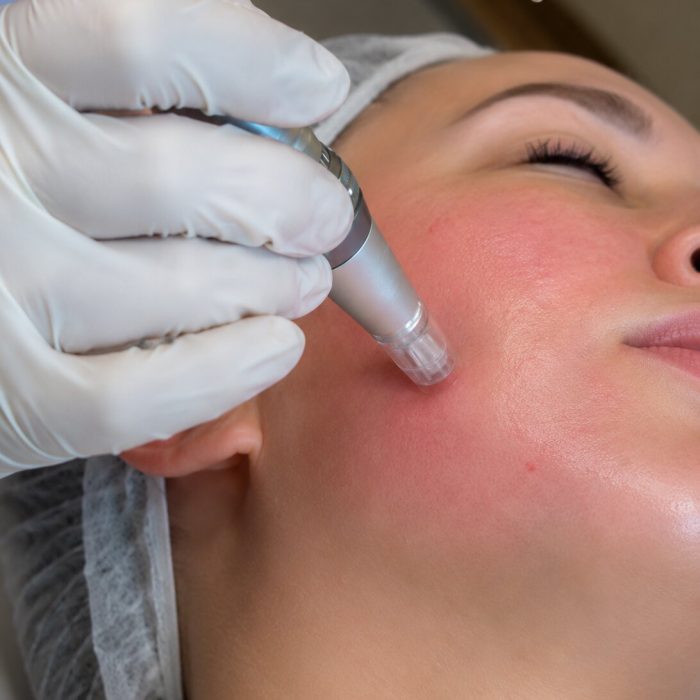 Vampire Facial IMG 2